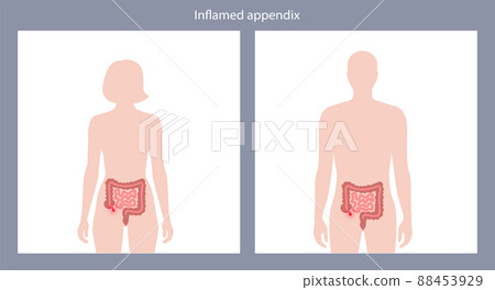 Appendix pain concept Appendix pain concept 88453929