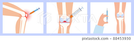 Knee Injection procedure Knee Injection procedure 88453930