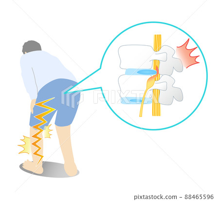 Illustrated illustration of a person with a lumbar disc hernia that hurts his leg 88465596
