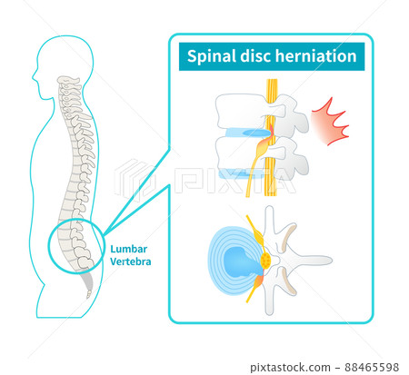 腰椎間盤突出症圖解 腰椎間盤突出症圖解 88465598