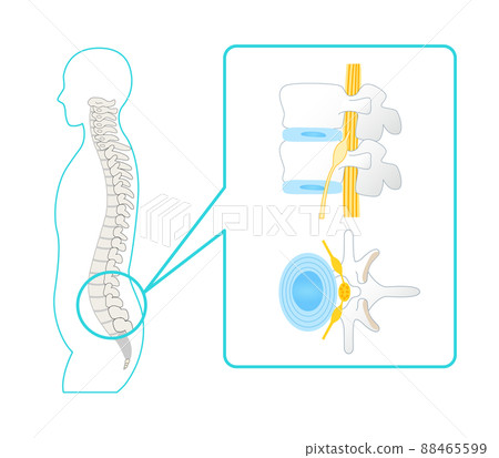 健康腰椎、椎骨和坐骨神經的插圖 88465599