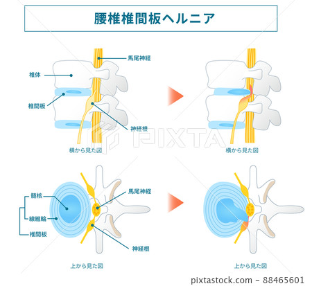 Illustrated illustration of lumbar disc hernia 88465601