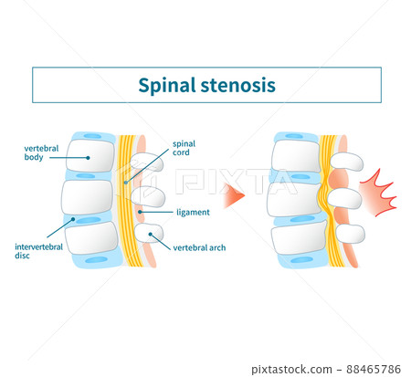 Illustrated illustration of lumbar spinal canal stenosis 88465786