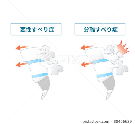 脊椎滑脫的插圖 88466629