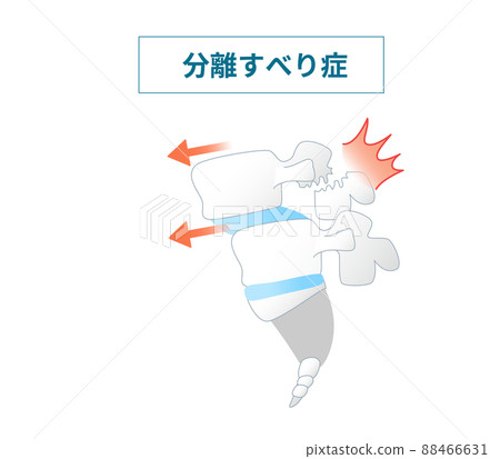 Illustrated illustration of spondylolisthesis Illustrated illustration of spondylolisthesis 88466631