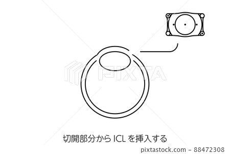 Illustrated ICL (Intraocular Contact Lens) Surgery, ICL Insertion 88472308