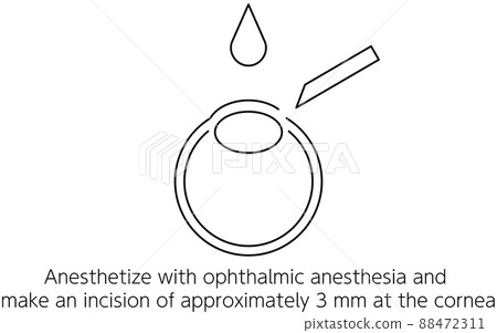 Illustrated ICL (Intraocular Contact Lens) Surgery, Incision 88472311