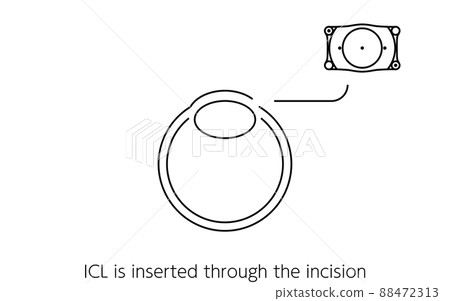 Illustrated ICL (Intraocular Contact Lens) Surgery, ICL Insertion Illustrated ICL (Intraocular Contact Lens) Surgery, ICL Insertion 88472313
