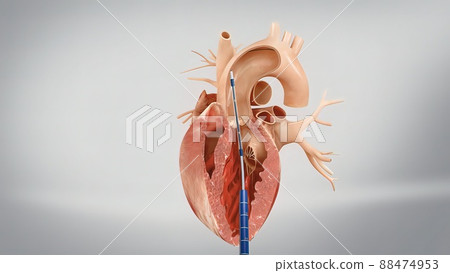 Coronary reimplantation in ascending aortic aneurysm Coronary reimplantation in ascending aortic aneurysm 88474953