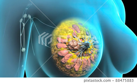 Breast cancer Girl with breast pathology. . Illustration and close-up of female human structure. Breast cancer Girl with breast pathology. . Illustration and close-up of female human structure. 88475883