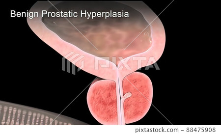 Benign Prostatic Hyperplasia 3d medical 88475908