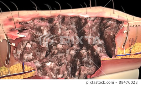 First Degree Burn epidermis 3d First Degree Burn epidermis 3d 88476028