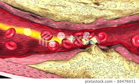Coronary atherosclerosis, light micrograph showing cholesterol-containing plaque Coronary atherosclerosis, light micrograph showing cholesterol-containing plaque 88476031
