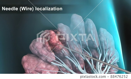 Breast cancer Girl with breast pathology. . Illustration and close-up of female human structure. 88476252