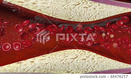 Atherosclerosis with cholesterol blood or plaque in vessel cause of coronary artery disease 88476257