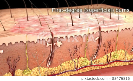 Skin anatomy diagram .Comparation good skin and skin with wrinkles. Illustration of skin cross section showing young skin and older skin Skin anatomy diagram .Comparation good skin and skin with wrinkles. Illustration of skin cross section showing young skin and older skin 88476816