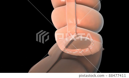 surgery to remove any part of the intestines, bowel resection surgery to remove any part of the intestines, bowel resection 88477411