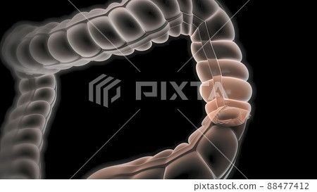 surgery to remove any part of the intestines, bowel resection surgery to remove any part of the intestines, bowel resection 88477412