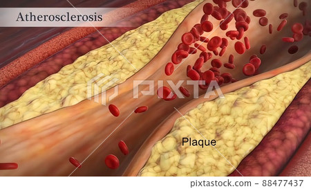 Clogged Artery with platelets and cholesterol plaque, concept for health risk for obesity 88477437