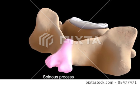 Pressure on nerves as a result of slipped disc 88477471