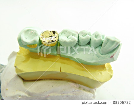 牙科金冠 牙科金冠 88506722
