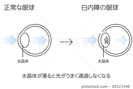 正常眼球和白內障眼球,插圖(線條圖) 正常眼球和白內障眼球,插圖(線條圖) 88523396