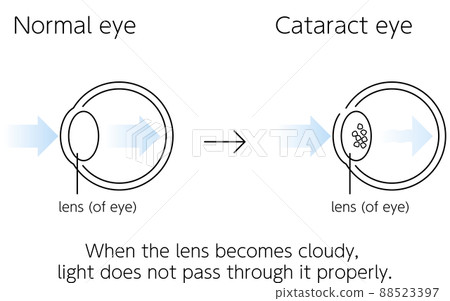 Normal eyeball and cataract eyeball, illustrated illustration (line drawing) 88523397
