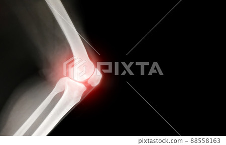 knee bone inflammation computer x-ray images 88558163