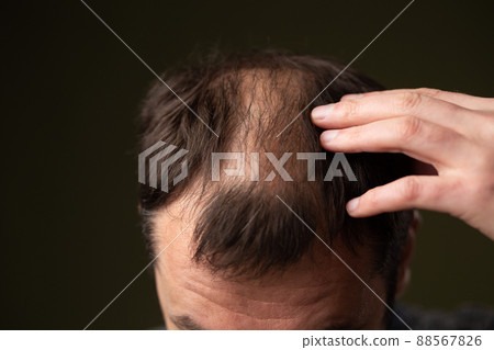 A man with baldness on a dark background head close-up. 88567826