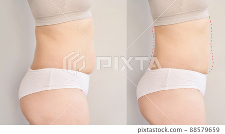 Before and after belly operation. Surgery cellulite tummy plastic change 88579659