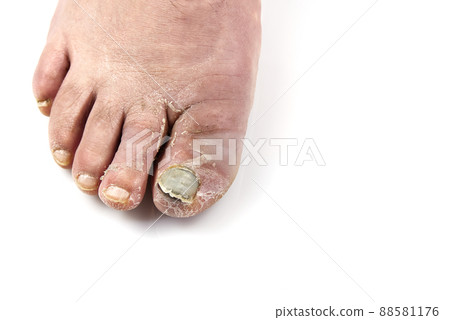 Sick nail on the foot. Toenail fungus isolated on white. Sore toenail, nail fungus close up photo 88581176