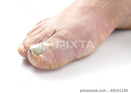 Sick nail on the foot. Toenail fungus isolated on white. Sore toenail, nail fungus close up photo 88581180
