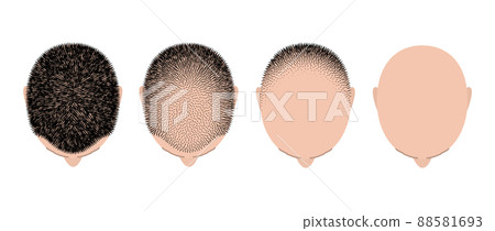 Hair loss bald head alopecia transplant growth vector top view. Hair loss men top view alopecia Hair loss bald head alopecia transplant growth vector top view. Hair loss men top view alopecia 88581693