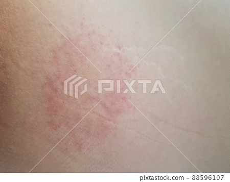 血管炎過敏性皮炎皮疹蕁麻疹-照片素材（圖片） [88596107] - PIXTA圖庫