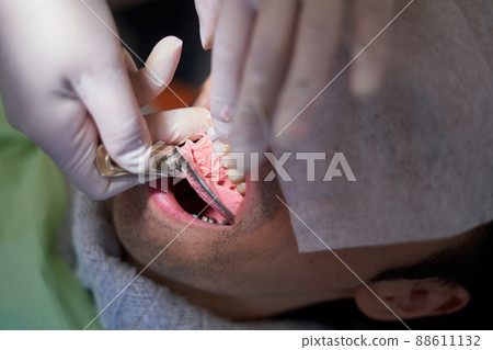 Tooth molding image 88611132