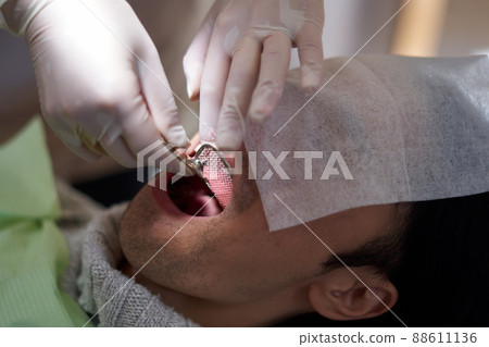 Tooth molding image 88611136