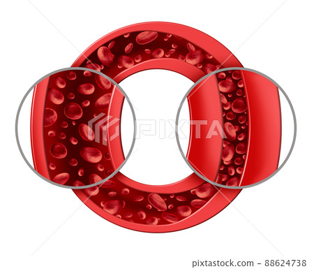 Hypertension And High Blood pressure 88624738