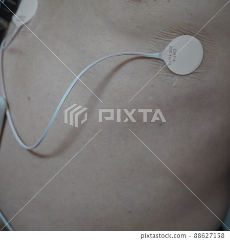 "Holter ECG wearing (left chest)" "Holter ECG wearing (left chest)" 88627158