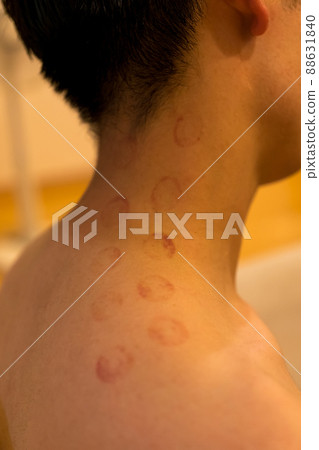 Sucker marks from shoulder to neck (internal bleeding) Sucker marks from shoulder to neck (internal bleeding) 88631840