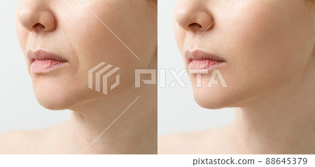 A close portrait of an aged woman before and after facial rejuvenation procedure. Correction of the chin shape liposuction of the neck. The result of the procedure in the clinic of aesthetic medicine. A close portrait of an aged woman before and after facial rejuvenation procedure. Correction of the chin shape liposuction of the neck. The result of the procedure in the clinic of aesthetic medicine. 88645379