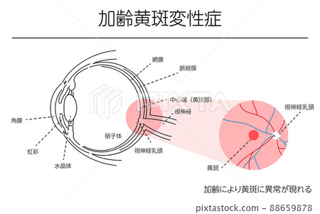 Illustration of eye disease and age-related macular degeneration 88659878