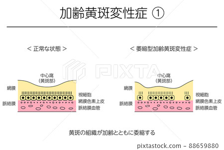 Illustration of eye disease, atrophic age-related macular degeneration 88659880