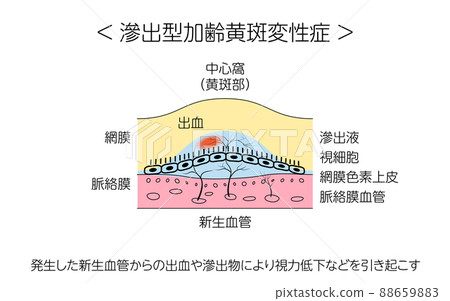 眼病、滲出性年齡相關性黃斑變性的圖示 眼病、滲出性年齡相關性黃斑變性的圖示 88659883