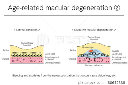 Illustration of eye disease, exudative age-related macular degeneration 88659886