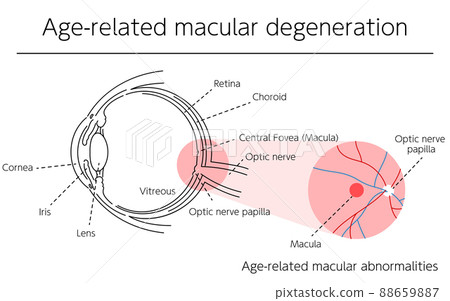 Illustration of eye disease and age-related macular degeneration 88659887