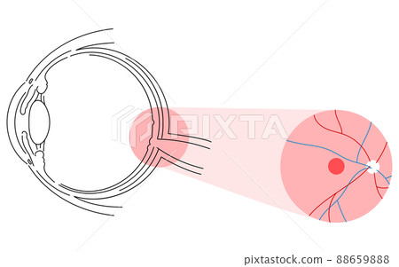 Illustration of eye disease and age-related macular degeneration 88659888