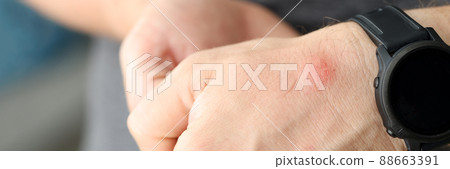 Closeup of red spot on skin of man hand Closeup of red spot on skin of man hand 88663391