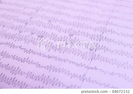 Results of electroencephalogram on paper, diagnostics of epilepsy Results of electroencephalogram on paper, diagnostics of epilepsy 88672132