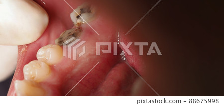 Decayed tooth root canal treatment. Tooth or teeth decay of lower molar. Restoration with a composite filling. Adult caries. bad teeth. Dental temporary restorative material. Dental concept. close up. 88675998