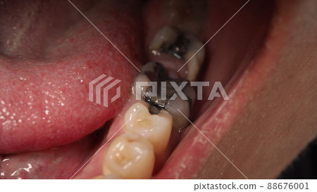 Decayed tooth root canal treatment. Tooth or teeth decay of lower molar. Restoration with a composite filling. Adult caries. bad teeth. Dental temporary restorative material. Dental concept. close up. 88676001